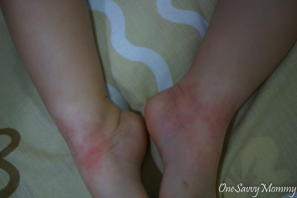 7 Steps in Healing Kids Eczema Naturally One Savvy Mommy